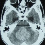 Chirurgie des tumeurs au cerveau tunisie