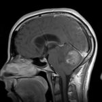 Chirurgie des tumeurs au cerveau tunisie