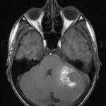 Chirurgie des tumeurs au cerveau tunisie