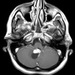 Chirurgie des tumeurs au cerveau tunisie