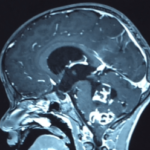 Chirurgie des tumeurs au cerveau tunisie