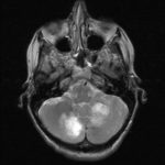 Chirurgie des tumeurs au cerveau Tunisie
