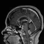 Chirurgie des tumeurs au cerveau tunisie
