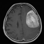 Chirurgie tumeur cérébrale Tunisie