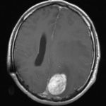 Chirurgie tumeur cérébrale Tunisie - Méningiome parasagittal