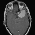 Chirurgie tumeur cérébrale Tunisie - Méningiome de l’ailesphénoïdale
