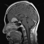Chirurgie tumeur cérébrale tunisie