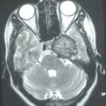 Chirurgie tumeur cérébrale tunisie