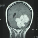 Chirurgie tumeur cérébrale tunisie