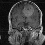Chirurgie tumeur cérébrale Tunisie