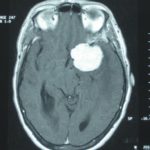 Chirurgie tumeur cérébrale Tunisie