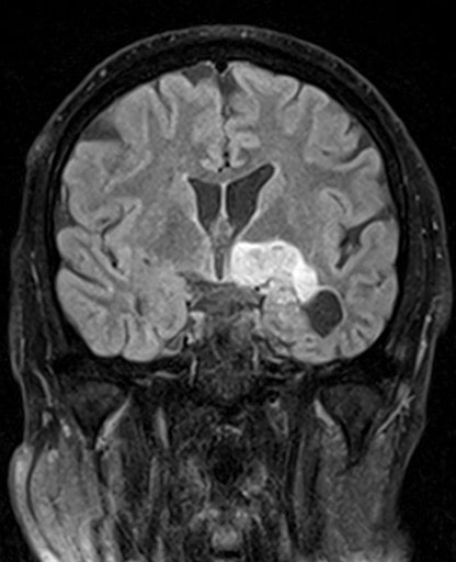 Chirurgie des tumeurs au cerveau tunisie