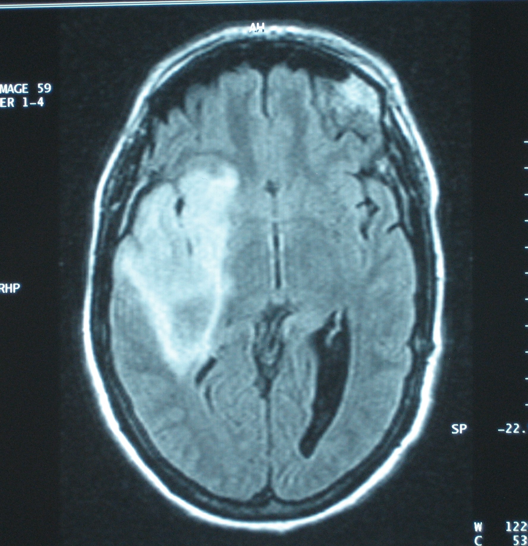 chirurgie tumeur cerebrale tunisie chirurgie des tumeurs au cerveau